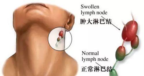 颈部淋巴结肿大_刺激天井穴保护淋巴结
