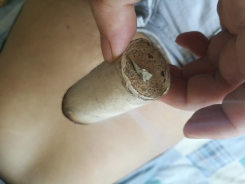 坚持中脘艾灸的奇迹