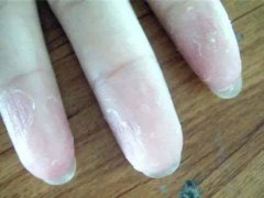 <b>手足脱屑艾灸的正确方法和穴位</b>