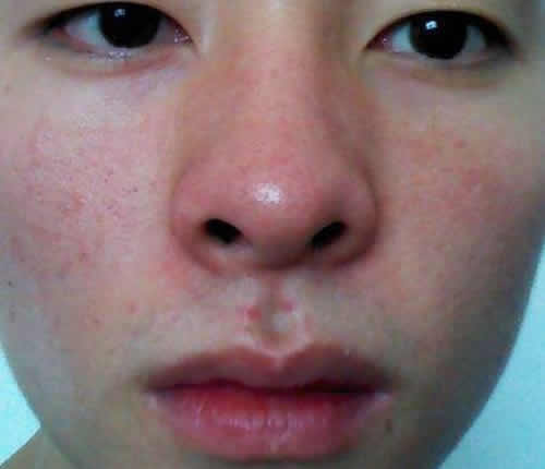 <b>红鼻子艾灸的正确方法和穴位</b>