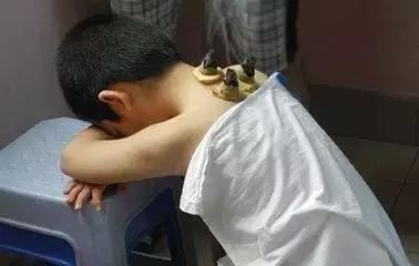 小儿尿频艾灸疗法  