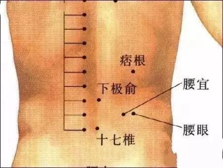 艾灸痞根穴治子宫肌瘤