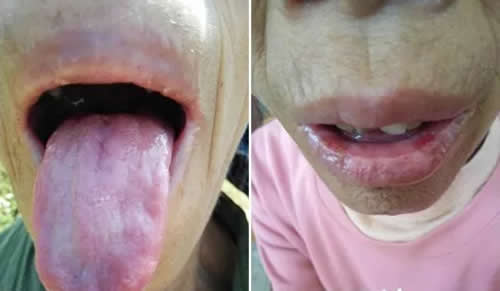 <b>口唇湿烂艾灸的正确方法和穴位</b>