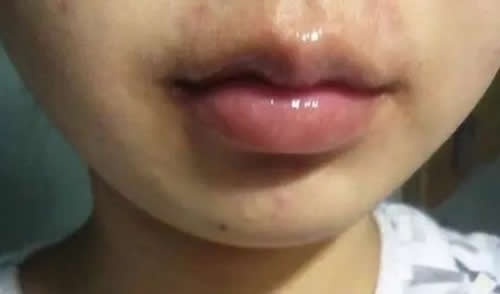口唇湿烂艾灸疗法