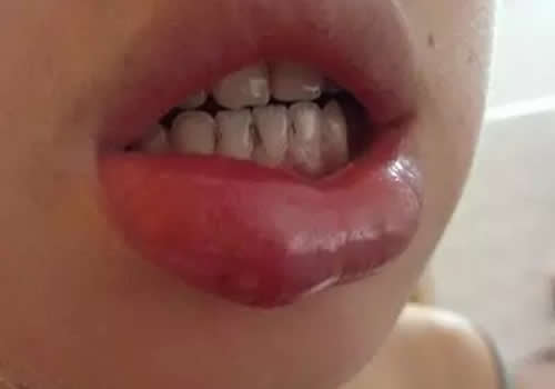 唇肿艾灸疗法