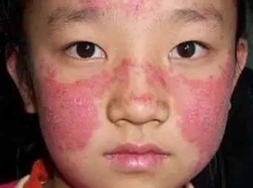 蝶形红斑