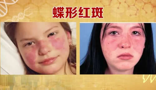蝶形红斑艾灸疗法