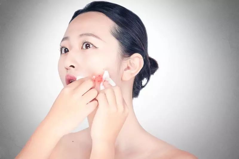 粉刺的艾灸疗法  