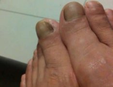 <b>足趾发黑艾灸穴位及治疗方法</b>