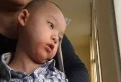 小儿痴呆治疗方法及艾灸穴位