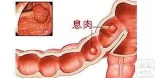 直肠息肉手术多少钱