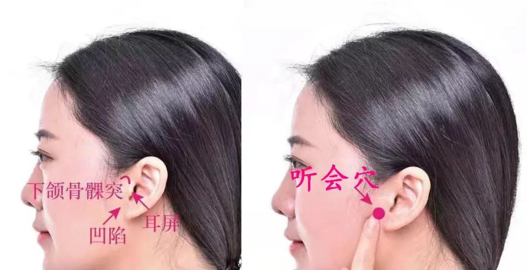 听会穴的准确穴位图及作用