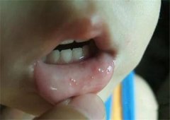 手足口病初期症状,尽早辨别疾病显象