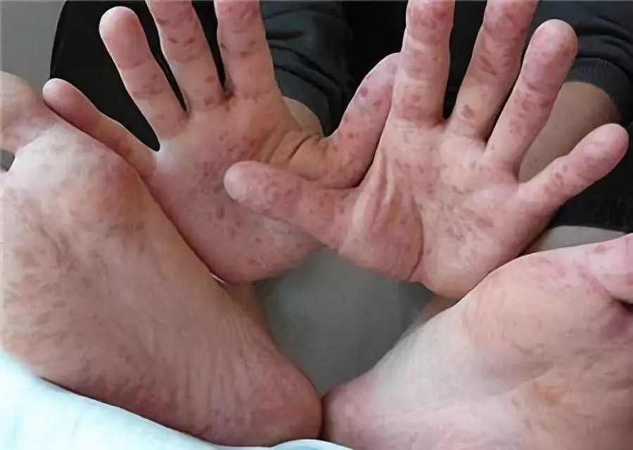 手足口病症状