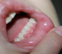 手足口病的症状如何预防