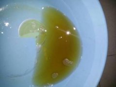小便黄赤的艾灸穴位及治疗方法