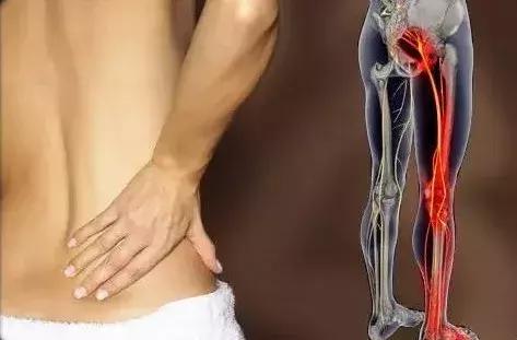 坐骨神经痛怎么办?找这几个穴位调理好!