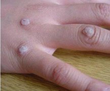 艾灸治疗瘊子(寻常疣)灸哪些穴位?