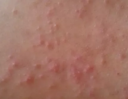 湿疹