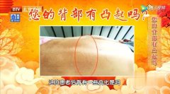 您的背部有凸起吗?实则必见,虚则必下!