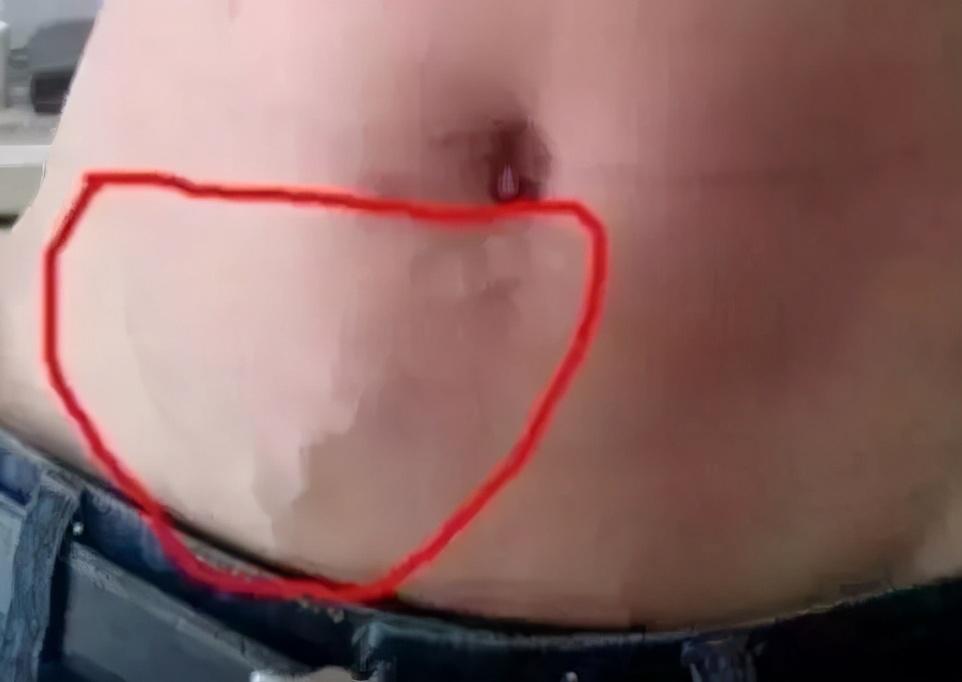 腹部青筋
