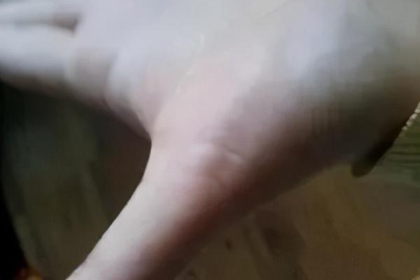 大鱼际诊法