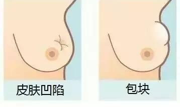 乳腺癌征象图送给女性朋友,远离乳腺癌!