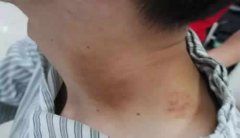 按摩刮痧后突然中风,这个部位不能随便按!